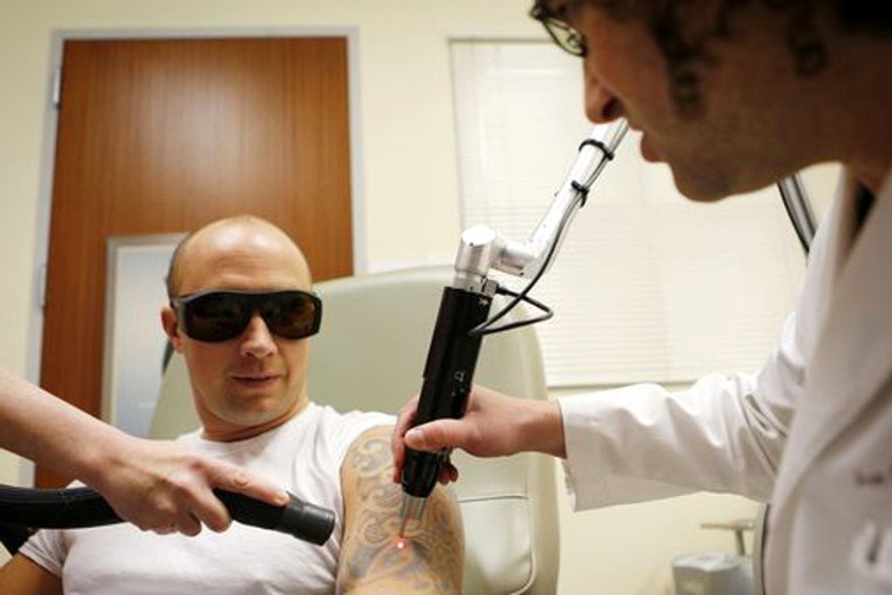 Laser Spectra Inovando o tratamento de remoção de tatuagem a laser